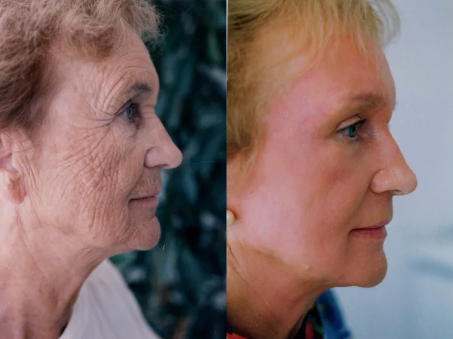 До и после — результат 1